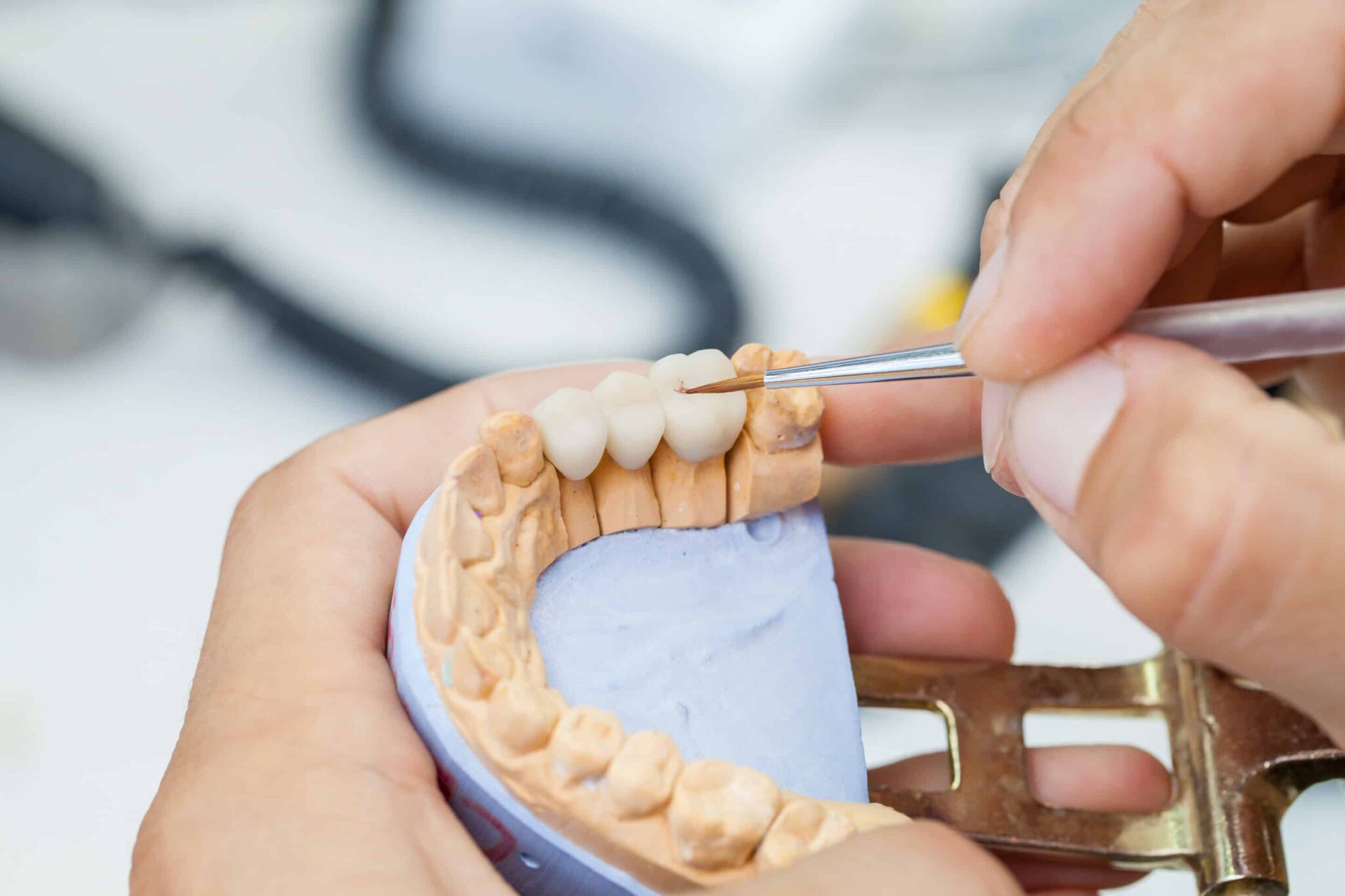dental crowns veneers dentist