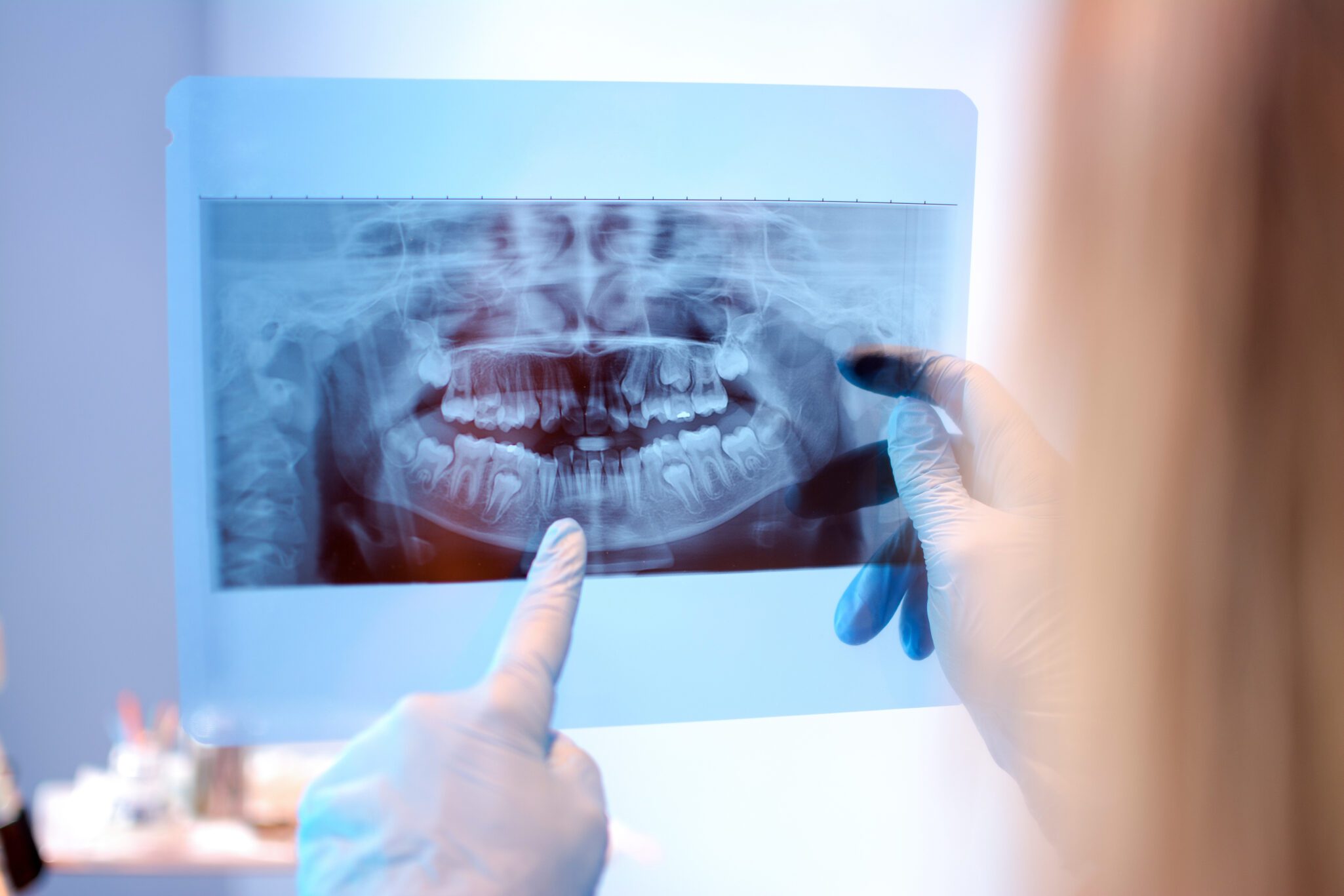 wisdom tooth pain Oral Surgery in Bakersfield