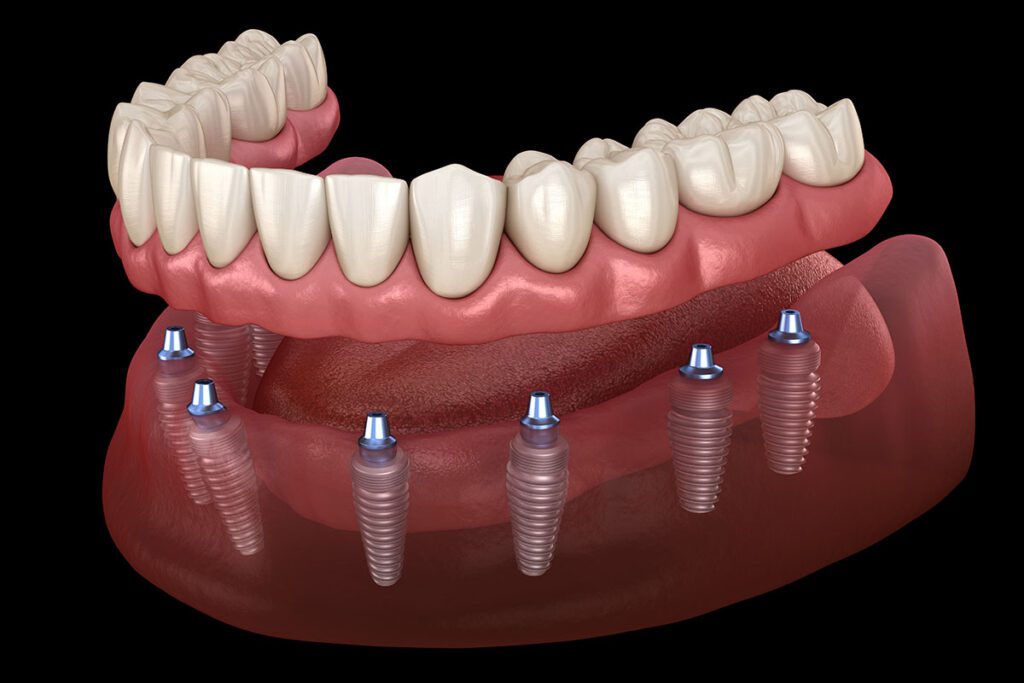 dental implants Prosthodontics in Bakersfield